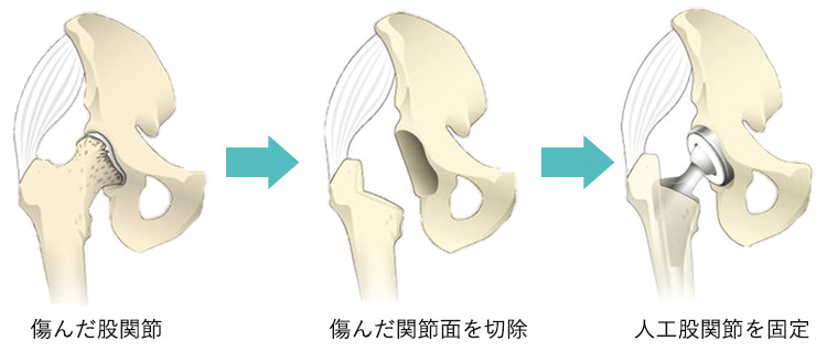 人工股関節置換術の流れのイメージ（傷んだ股関節の関節面を切除→人工股関節を固定）