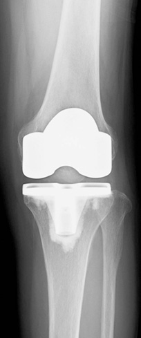 人工膝関節全置換術後のレントゲン写真