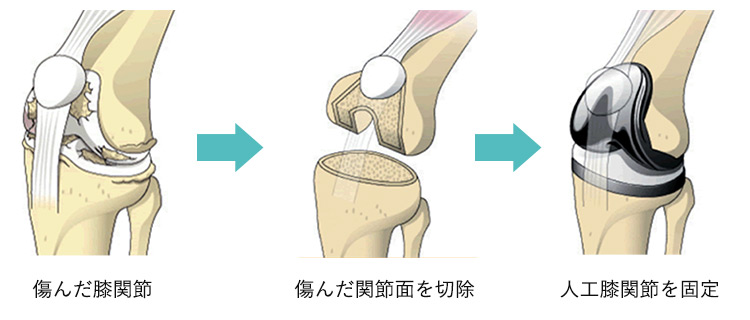 人工膝関節全置換術の流れのイメージ（傷んだ膝関節の関節面を切除→人工膝関節を固定）