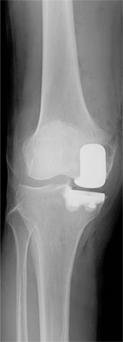 人工膝関節単顆置換術後のレントゲン写真