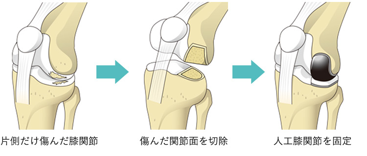 人工膝関節単顆置換術の流れのイメージ（片方だけ傷んだ膝関節の関節面を切除→人工膝関節を固定）