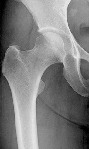 正常股関節のレントゲン写真