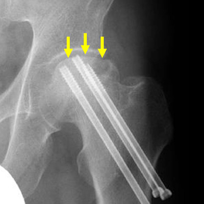 大腿骨頚部骨折後の大腿骨頭壊死のレントゲン写真