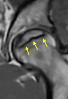MRI画像：壊死範囲が比較的狭い