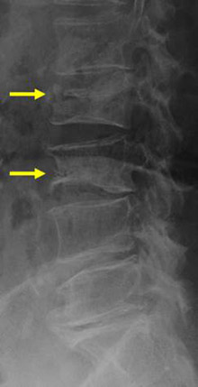 椎体圧迫骨折のレントゲン写真