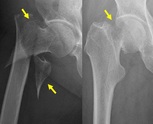 大腿骨近位部骨折のレントゲン写真