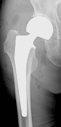 大腿骨頚部骨折の術後レントゲン写真