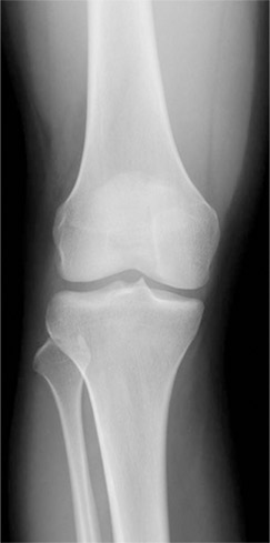 正常な膝のレントゲン写真