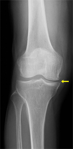 変形性膝関節症初期のレントゲン写真