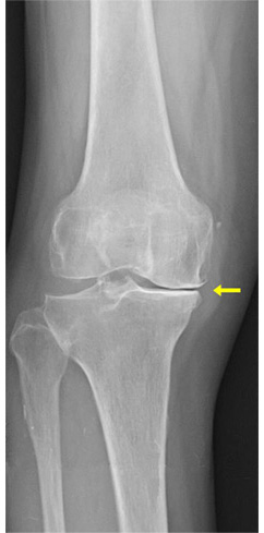変形性膝関節症末期のレントゲン写真