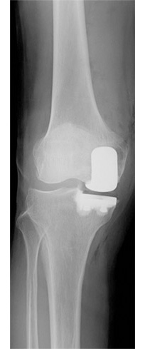 人工膝関節単顆置換術のレントゲン写真