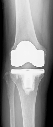 人工膝関節全置換術のレントゲン写真