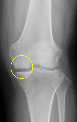 特発性膝骨壊死のレントゲン写真