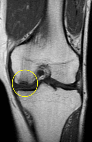 特発性膝骨壊死のMRI写真