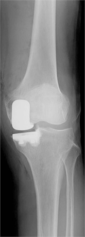 人工膝関節単顆置換術のレントゲン写真
