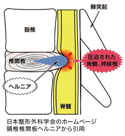 頸椎椎間板ヘルニアの図画（日本整形外科学会HP 頸椎椎間板ヘルニア から引用）