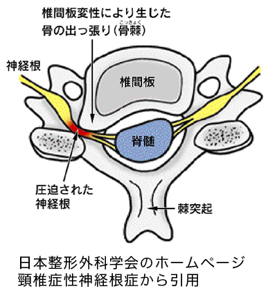 頸椎症性神経根症の図画（日本整形外科学会HP 頸椎症性神経根症 から引用）