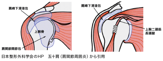 五十肩のイメージ：日本整形外科学会のHP　五十肩（肩関節周囲炎）から引用