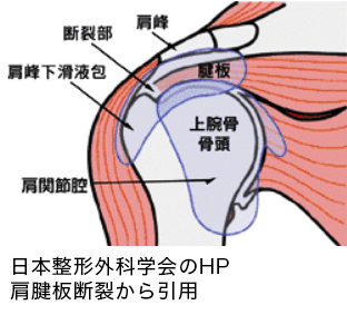 腱板断裂イメージ：日本整形外科学会のHP 肩腱板断裂から引用