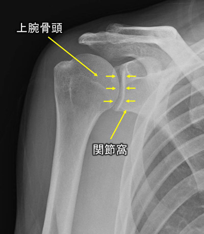 正常な肩関節のレントゲン写真